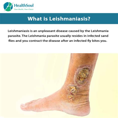 Leishmaniasis Symptoms And Treatment Healthsoul
