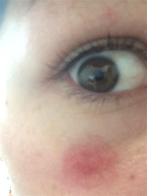 Red Dark Circle Spot Underneath Eye Rosacea And Facial Redness