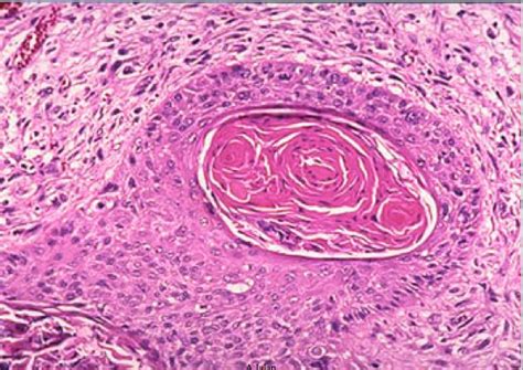 A keratin pearl is a keratinized structure found in regions where abnormal squamous cells form concentric layers. Respiratory Pathology - Pathology Mpat80001 with Dr.roy at ...