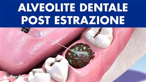 Alveolite Dentale Post Estrazione Del Dente Cause E Trattamento Youtube