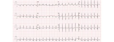 How To Read A Paediatric Ecg Medical Exam Prep