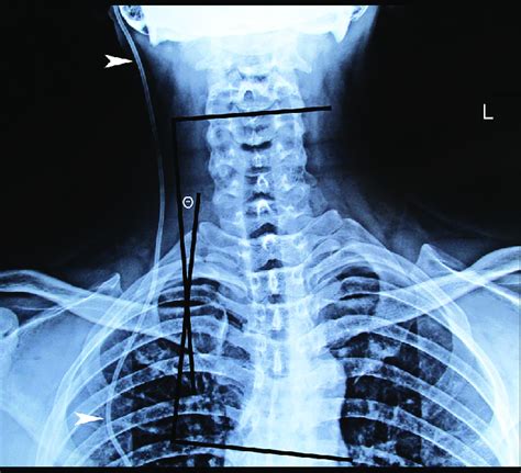 Anteroposterior Cervical Spine Radiograph The Patients Cervical Spine