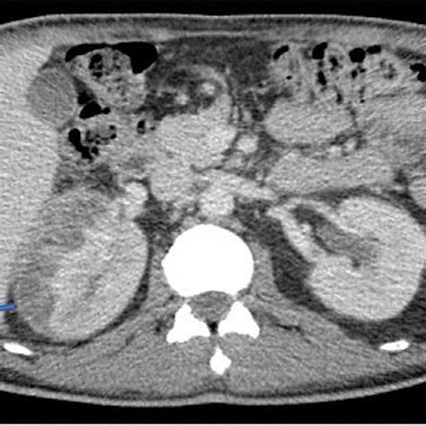 Axial Contrast Enhanced Ct Demonstrating Perinephric Renal Abscess On