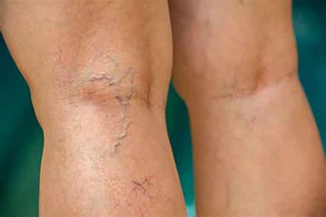 Early Signs Of Venous Insufficiency