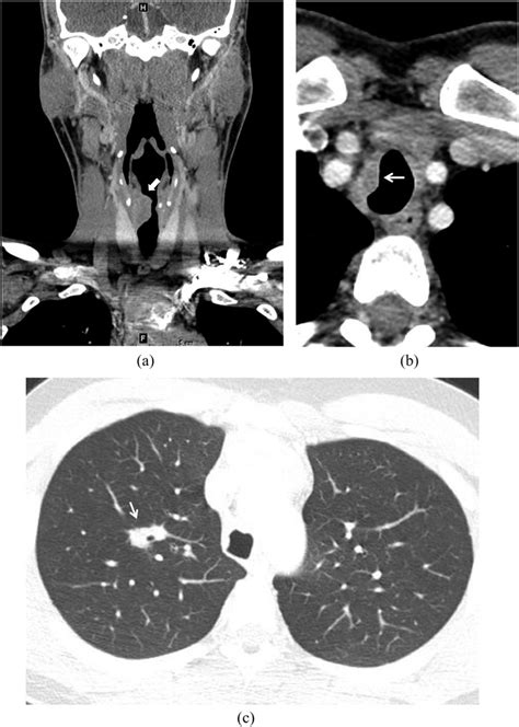 Airways And Lung Involvement In Rosai Dorfman Disease Coronal Contrast