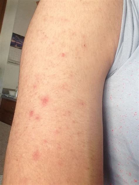 Skin Concern I Keep My Arms As Clean As I Can This Has Been Going On
