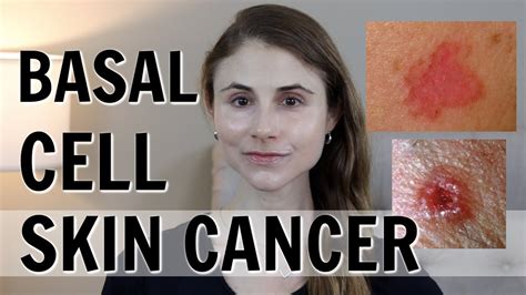Basal Cell Skin Cancer What You Should Know Dr Dray Youtube