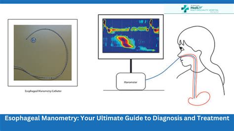 Esophageal Manometry: Your Ultimate Guide to Diagnosis and Treatment
