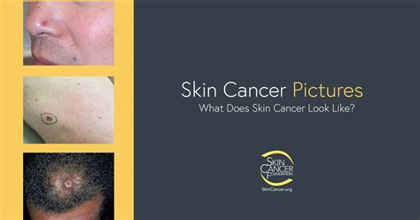 Fotos De C Ncer De Piel The Skin Cancer Foundation