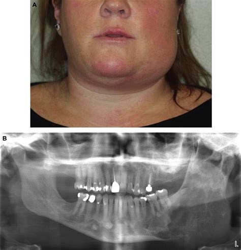 Osteosarcoma Of The Mandible Arising In Fibrous Dysplasia—a Case Report