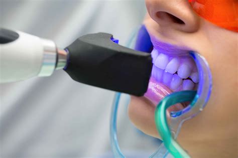 Teeth Whitening Mid North Coast Fresh Dental Care