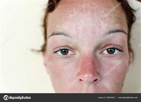 Sunburn And Red Skin Stock Photo By ©focusandblur 168833620
