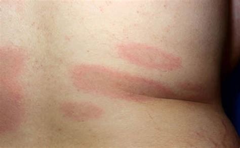 Lyme Disease Rash Causes Symptoms Diagnosis And Treatment