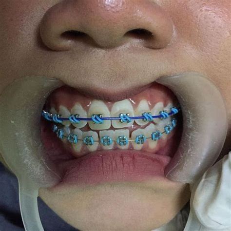 Pin By John Beeson On Orthodontic Braces In 2021 Braces Colors Teeth