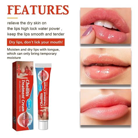 20g Cheilitis Treatment Cream For Dry Chapped Cracked Peeling And