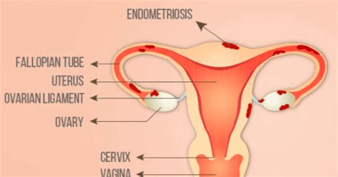 Endometriosis news is strictly a news and information website about the disease. Mohak IVF: Endometriosis Treatments