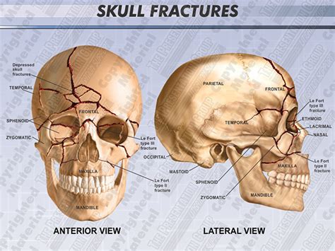 Skull Fractures Medical Legal Illustration