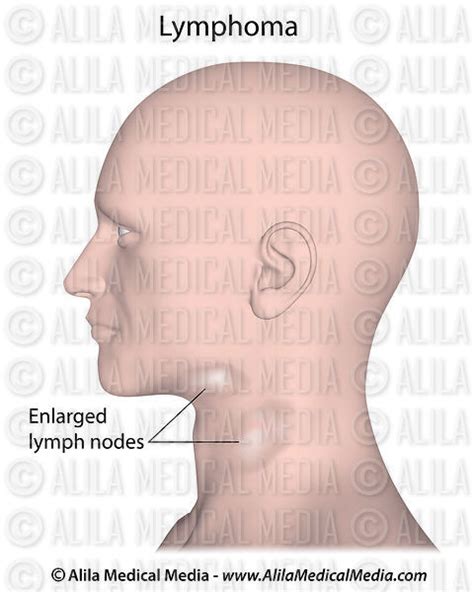 Alila Medical Media Ent Otolaryngology Images And Videos