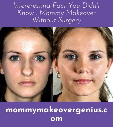 Mommy Makeover Facts You Didnt Know Makeover