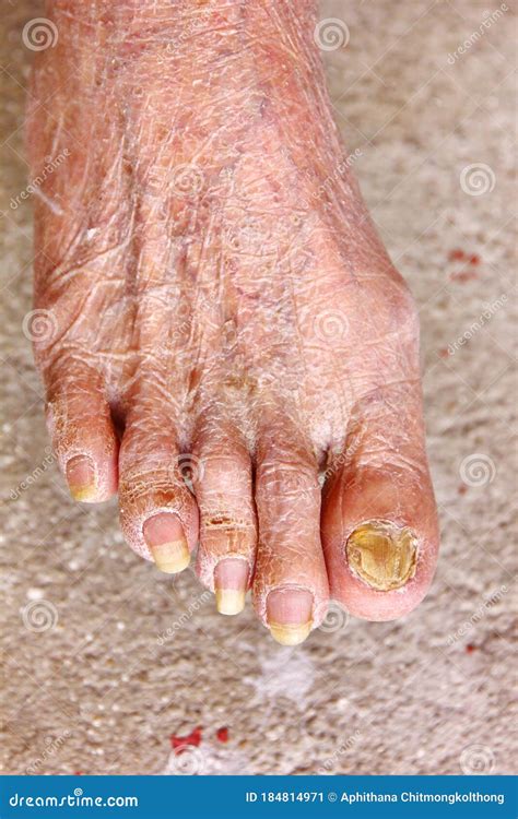 Dry Skin With Toenail Fungus On Old Woman Leg Stock Image Image Of