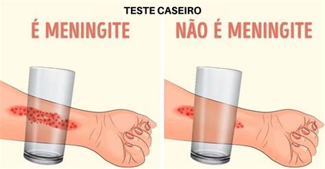 Teste De Caxumba Caseiro
