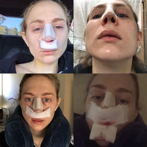 Nose Job Surgery Recovery Cast Removal And Two Week Post Op Reveal