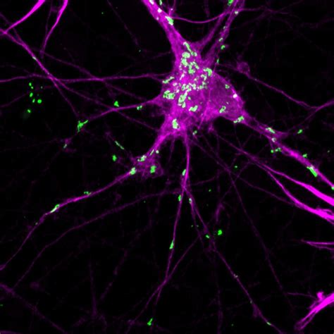 Shining A Light On Protein Aggregation In Parkinsons Disease