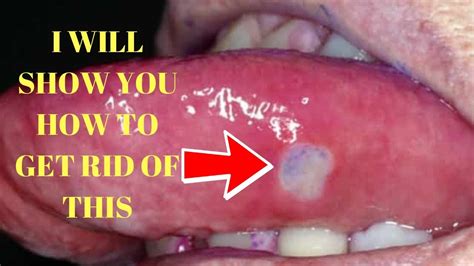 How To Get Rid Of Canker Sores On Tongue Canker Sores In Mouth
