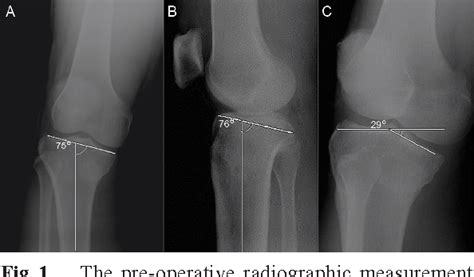 Figure 1 From Uni Condyle High Tibial Osteotomy For Malunion Of Medial