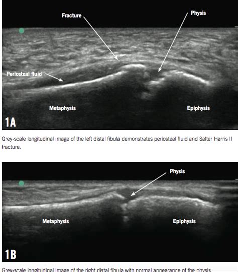 Point Of Care Ultrasonography For Bone Injury A Boy With A Distal