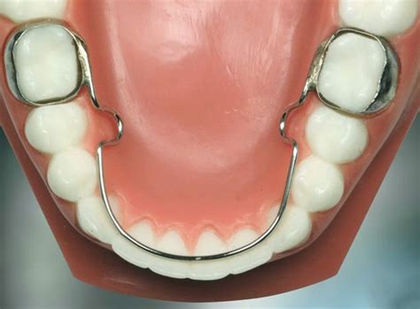 Lingual Arch Dunn Orthodontics