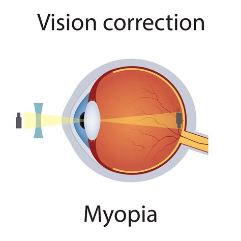 Vision Correction Of Myopia Illustration Eyesight Disorders Eyes