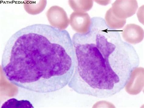 Acute Monoblastic Monocytic Leukemia Aml M5 Histopathology Image