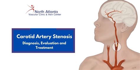 Ppt Treatment For Asymptomatic Carotid Artery Stenosis Surgery Or Hot
