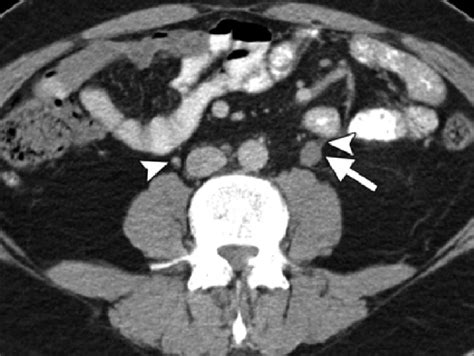 Gonadal Pathway Axial Contrast Enhanced Ct Image Shows An Enlarged