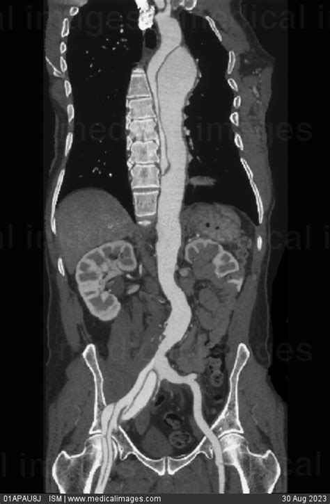 Stock Image Angio Ct Of The Thoracic Abdominal Aorta Frontal View
