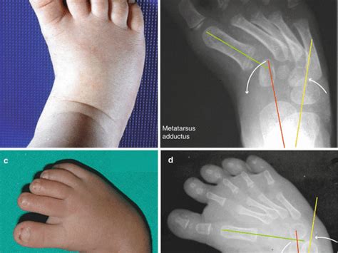 How To Fix Flat Feet In Child Pronation In Kids Answers To Your