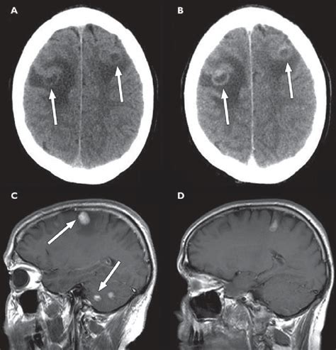 Year Old Man With History Of Follicular Lymphoma Who Presented With
