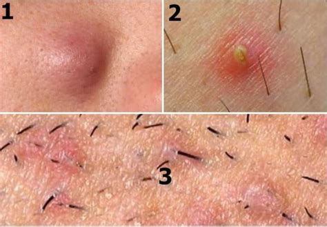 In time, this can grow into a painful, boil or cyst under the skin that fills with pus. Causes Symptoms Treating and Preventing Ingrown Hair ...