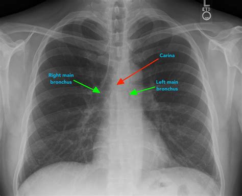 Beautiful How To Check X Ray Report Of Chest Write Incident