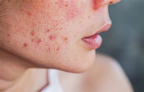 Hydrocortisone For Acne How It Works How To Use It And More