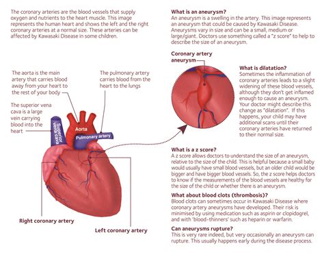 What Is A Coronary Artery Aneurysm 02 Societi