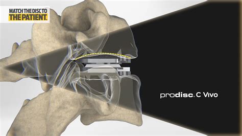 Centinel Spine For Prodisc® Motion Preservationdisc Arthroplasty And