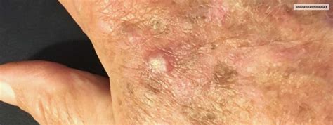 Actinic Keratosis Treatments That You Need To Know About In 2023