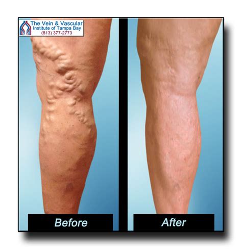 Tampa Varicose Vein Removal Before And After Pictures 813 377 2773