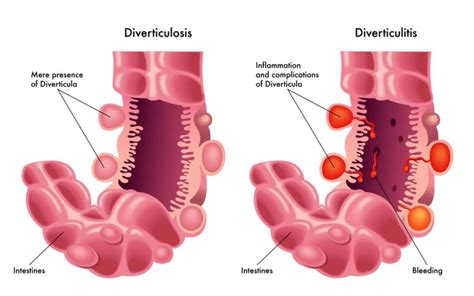 Gastroenterologists In Florida Diverticular Disease