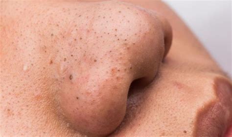 Blackhead Removal Hack Why You Should Never Use Vaseline To Get Rid Of