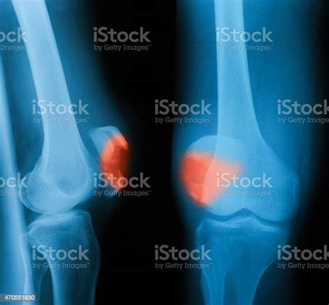 Xray Image Of Knee Joint Ap And Lateral View Stock Photo Download