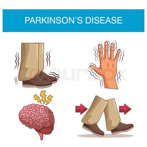 Parkinsons Disease Infographic Stock Vector Colourbox