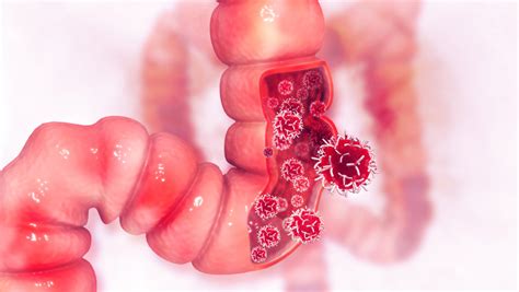 Researchers Investigate Factors Determining The Response Of Colorectal